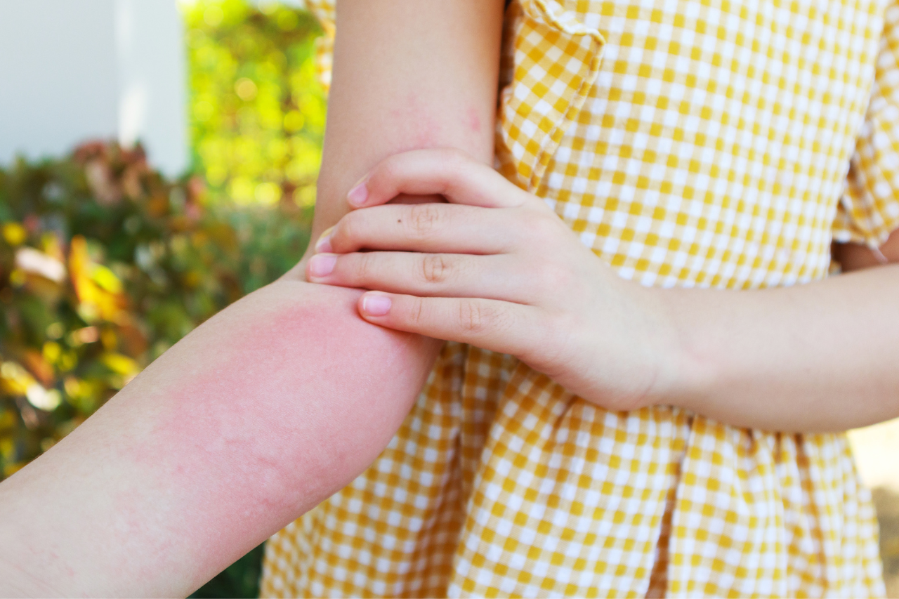 Infected Bug Bite: When to See a Doctor, Possible Complications