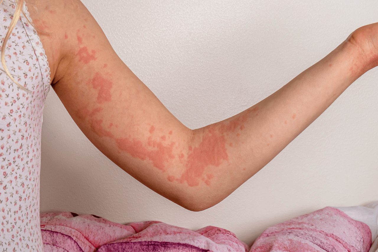 What Causes Hives (Urticaria)?