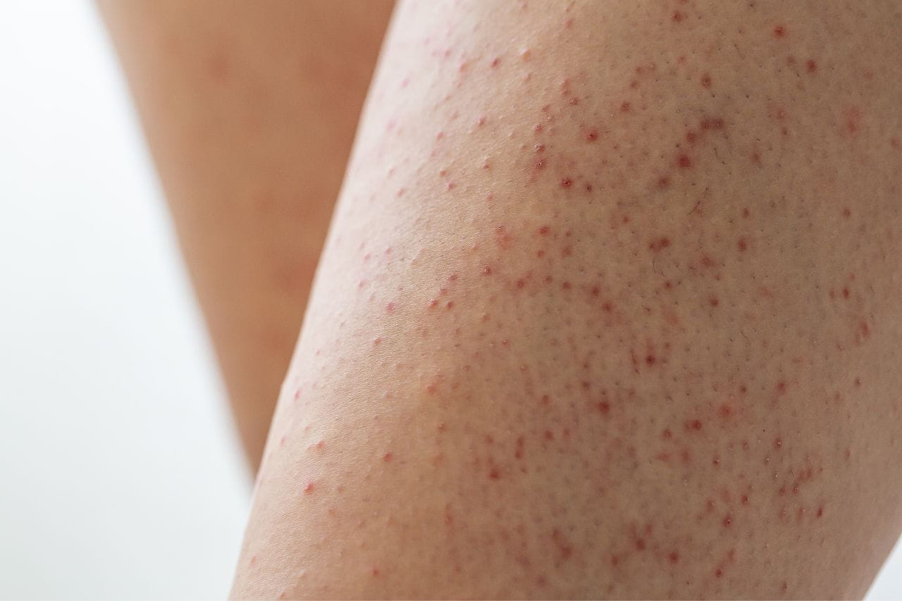 Keratosis Pilaris Symptoms Causes And Treatment Vrogue co