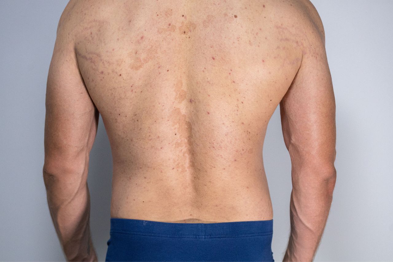 Tinea Versicolor Unveiled: Causes, Symptoms, and Solutions 
