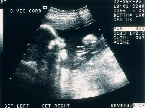 sonogram picture