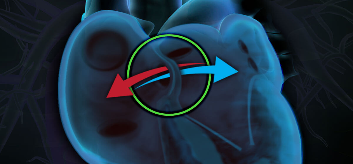 atrial septal defect