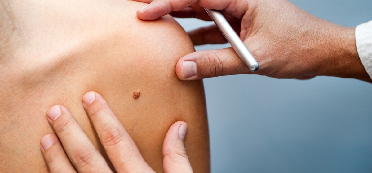 skin cancer early stages