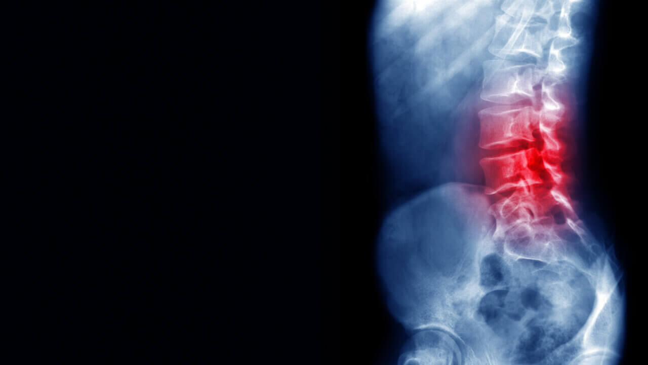 Will My Herniated Disc Heal On Its Own? - Neurosurgery & Spine Consultants