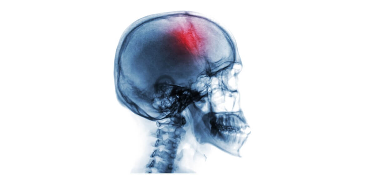 stroke causes and risk factors